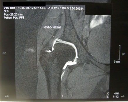 lesão labral